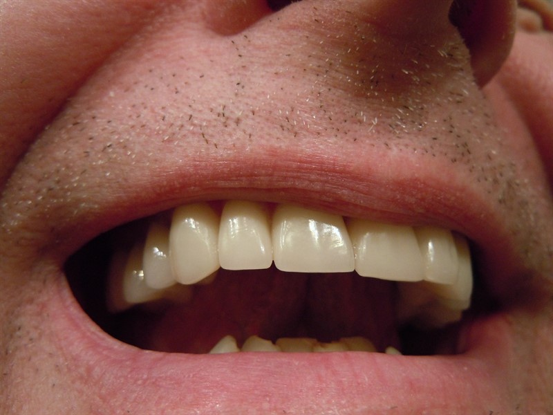 הלבנת שיניים בלייזר