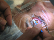 כמה עולה ניתוח לייזר בעיניים